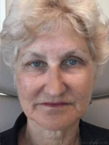 Dermal filler treatment patient photo, front view of the face — Dr. Rudderman, Atlanta.