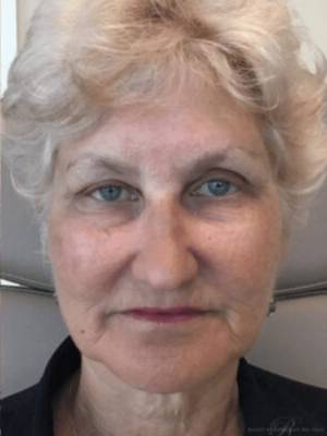 Dermal filler treatment patient photo, front view of the face — Dr. Rudderman, Atlanta.