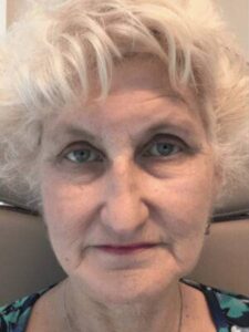 Dermal filler treatment patient photo, front view of the face — Dr. Rudderman, Atlanta.