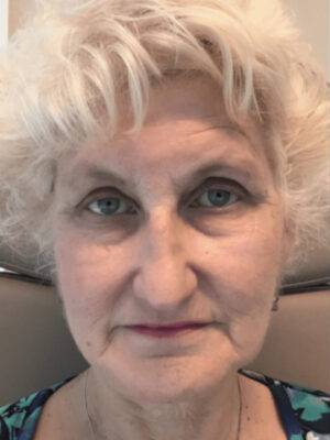 Dermal filler treatment patient photo, front view of the face — Dr. Rudderman, Atlanta.