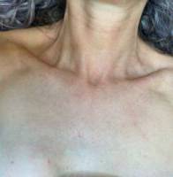 Chest and décolletage before IPL photofacial, front view — Dr. Rudderman, Atlanta.