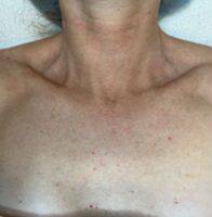 IPL photofacial patient photo, front view of the chest and décolletage — Dr. Rudderman, Atlanta.