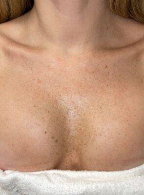 Chest and décolletage before IPL photofacial, front view — Dr. Rudderman, Atlanta.