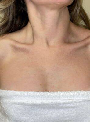 Chest and décolletage after IPL photofacial, front view — Dr. Rudderman, Atlanta.