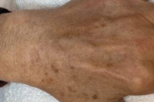 Hand before IPL photofacial, front view — Dr. Rudderman, Atlanta.
