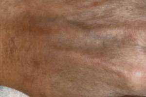 Hand after IPL photofacial, front view — Dr. Rudderman, Atlanta.