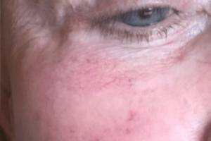 Cheek before IPL photofacial, three-quarter view — Dr. Rudderman, Atlanta.