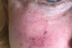 Cheek before IPL photofacial, three-quarter view — Dr. Rudderman, Atlanta.
