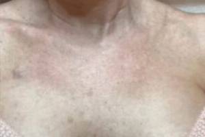 Chest and décolletage after IPL photofacial, front view — Dr. Rudderman, Atlanta.