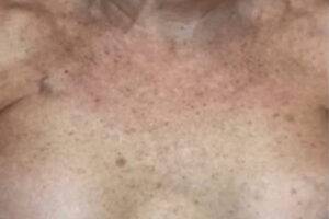 Chest and décolletage before IPL photofacial, front view — Dr. Rudderman, Atlanta.