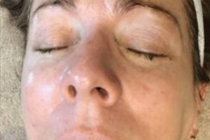 Face after IPL photofacial, front view — Dr. Rudderman, Atlanta.