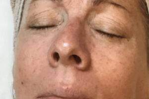 Face before IPL photofacial, front view — Dr. Rudderman, Atlanta.