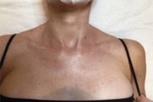 Chest and décolletage after IPL photofacial, front view — Dr. Rudderman, Atlanta.