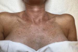 Chest and décolletage before IPL photofacial, front view — Dr. Rudderman, Atlanta.
