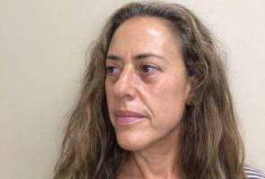 Face before microneedling, three-quarter view — Dr. Rudderman, Atlanta.