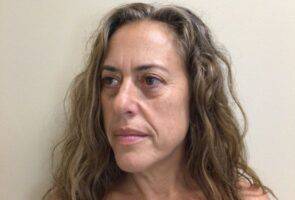 Face after microneedling, three-quarter view — Dr. Rudderman, Atlanta.