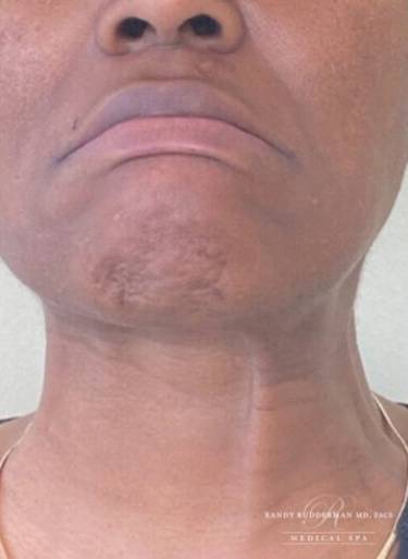 Neuromodulator treatment patient photo, front view of the face — Dr. Rudderman, Atlanta.