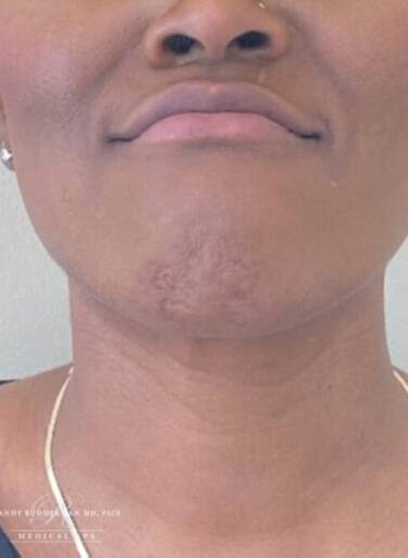 Neuromodulator treatment patient photo, front view of the face — Dr. Rudderman, Atlanta.