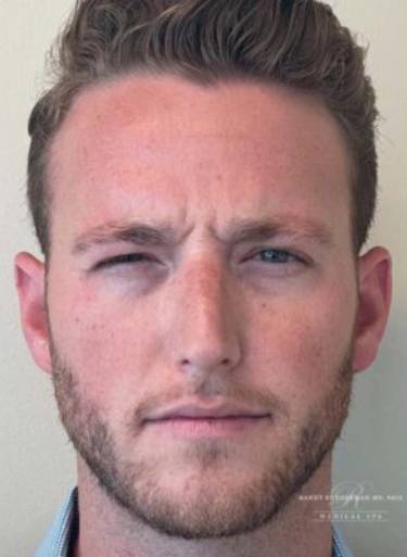 Neuromodulator treatment patient photo, front view of the face — Dr. Rudderman, Atlanta.