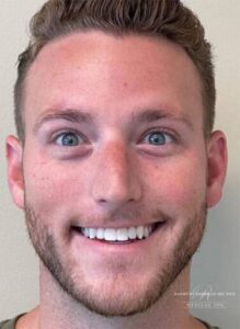 Neuromodulator treatment patient photo, front view of the face — Dr. Rudderman, Atlanta.