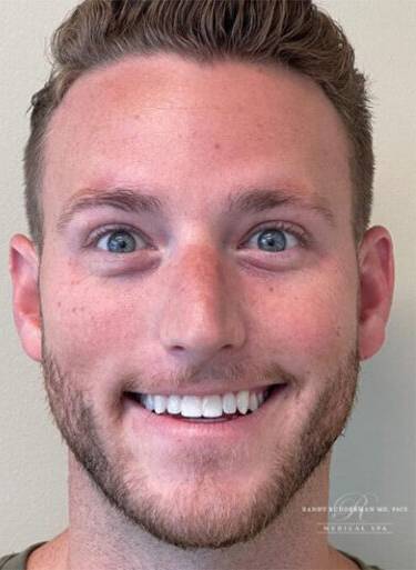 Neuromodulator treatment patient photo, front view of the face — Dr. Rudderman, Atlanta.