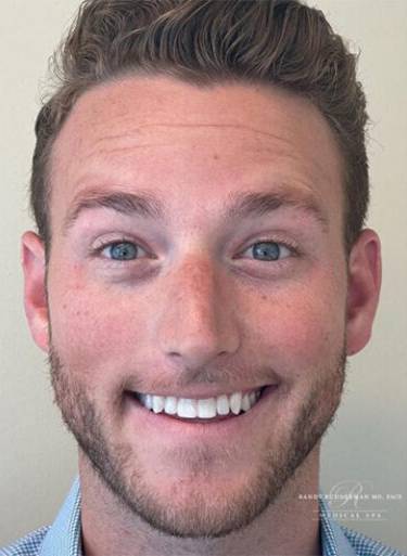 Neuromodulator treatment patient photo, front view of the face — Dr. Rudderman, Atlanta.