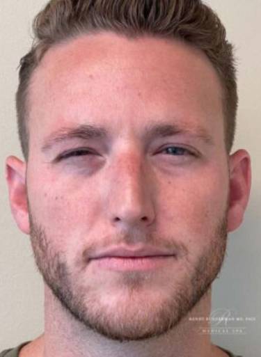 Neuromodulator treatment patient photo, front view of the face — Dr. Rudderman, Atlanta.