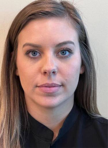 Neuromodulator treatment patient photo, front view of the face — Dr. Rudderman, Atlanta.