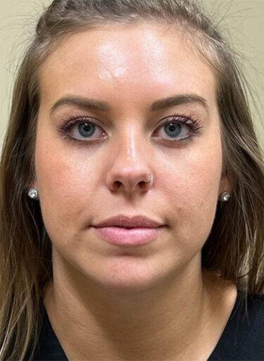 Neuromodulator treatment patient photo, front view of the face — Dr. Rudderman, Atlanta.