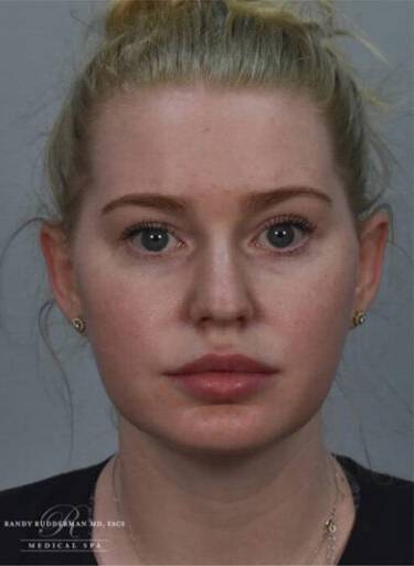 Neuromodulator treatment patient photo, front view of the face — Dr. Rudderman, Atlanta.