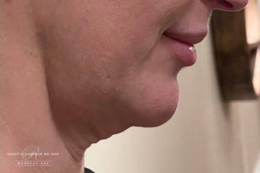 Neuromodulator treatment patient photo, side profile view of the face — Dr. Rudderman, Atlanta.