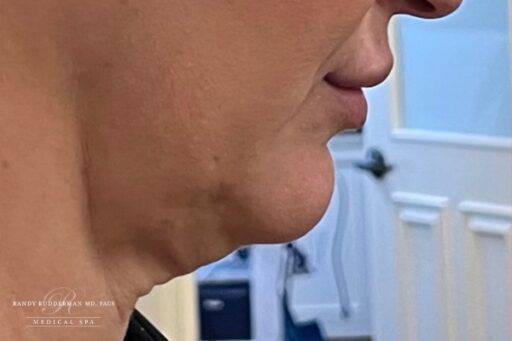 Neuromodulator treatment patient photo, side profile view of the face — Dr. Rudderman, Atlanta.