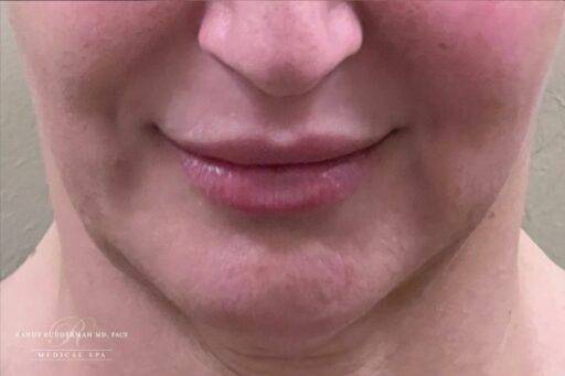 Neuromodulator treatment patient photo, front view of the face — Dr. Rudderman, Atlanta.