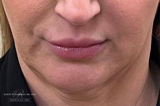 Neuromodulator treatment patient photo, front view of the face — Dr. Rudderman, Atlanta.
