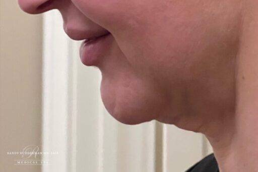 Neuromodulator treatment patient photo, side profile view of the face — Dr. Rudderman, Atlanta.