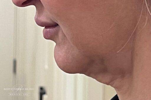 Neuromodulator treatment patient photo, side profile view of the face — Dr. Rudderman, Atlanta.
