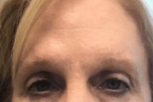 Neuromodulator treatment patient photo, front view of the face — Dr. Rudderman, Atlanta.