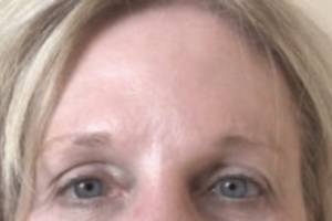 Neuromodulator treatment patient photo, front view of the face — Dr. Rudderman, Atlanta.