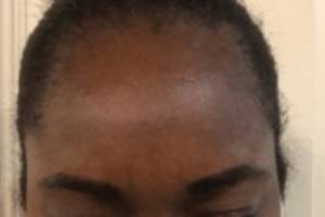 Neuromodulator treatment patient photo, front view of the face — Dr. Rudderman, Atlanta.