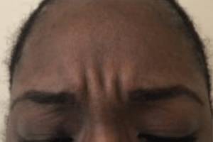 Face before neuromodulator treatment, front view — Dr. Rudderman, Atlanta.