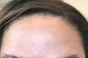Neuromodulator treatment patient photo, front view of the face — Dr. Rudderman, Atlanta.