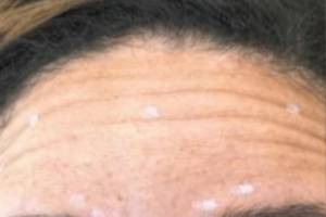 Face before neuromodulator treatment, front view — Dr. Rudderman, Atlanta.