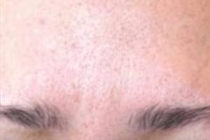 Neuromodulator treatment patient photo, front view of the face — Dr. Rudderman, Atlanta.