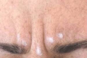 Face before neuromodulator treatment, front view — Dr. Rudderman, Atlanta.