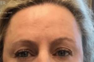 Neuromodulator treatment patient photo, front view of the face — Dr. Rudderman, Atlanta.
