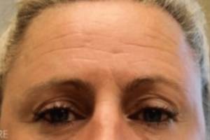 Face before neuromodulator treatment, front view — Dr. Rudderman, Atlanta.