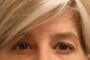 Neuromodulator treatment patient photo, front view of the face — Dr. Rudderman, Atlanta.
