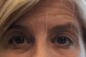Neuromodulator treatment patient photo, front view of the face — Dr. Rudderman, Atlanta.