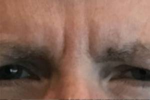 Neuromodulator treatment patient photo, front view of the face — Dr. Rudderman, Atlanta.