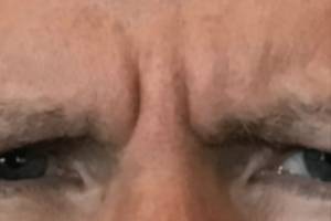 Face before neuromodulator treatment, front view — Dr. Rudderman, Atlanta.